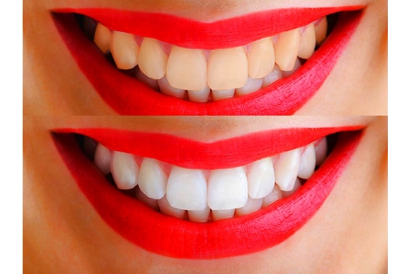 Внутрикоронковое отбеливание девитальных зубов