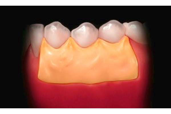 Наложение лечебно-защитной повязки  (1 группа зубов)
