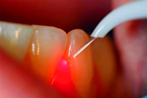 Фотодинамическая терапия (1 зуб)