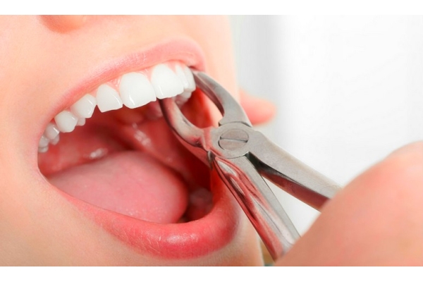 Сложное удаление зуба Томск Чувашский стоматология томск цены на протезирование зубов в