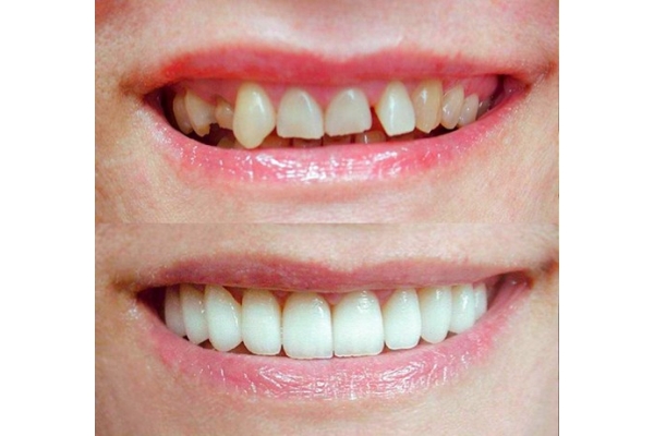 Художественная реставрация и эстетическая корректировка фронтальных зубов