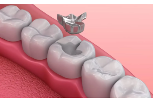 Металлическая зубная вкладка