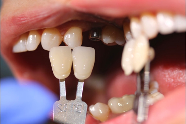 Израильские импланты зубов