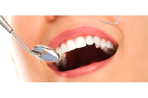 Восстановление зуба виниром Е-мах