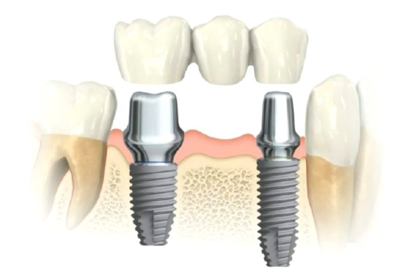 Протезирование зуба с использованием имплантата коронкой на основе диоксида циркония