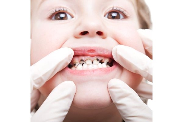 Лечение пульпита постоянного зуба (1 канал) + частичная реставрация