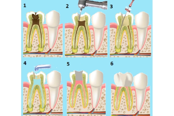 Лечение периодонтита постоянного зуба (2 канала)+ полная реставрация (последнее посещение)