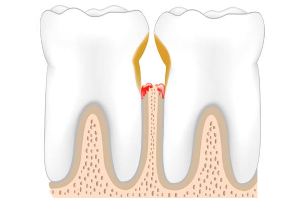 Лечение периодонтита постоянного зуба (3 канала)+ полная реставрация