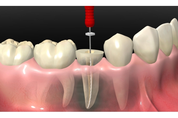 Лечение пульпита 3 корневого зуба