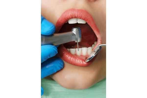 Лечение клиновидного дефекта зуба