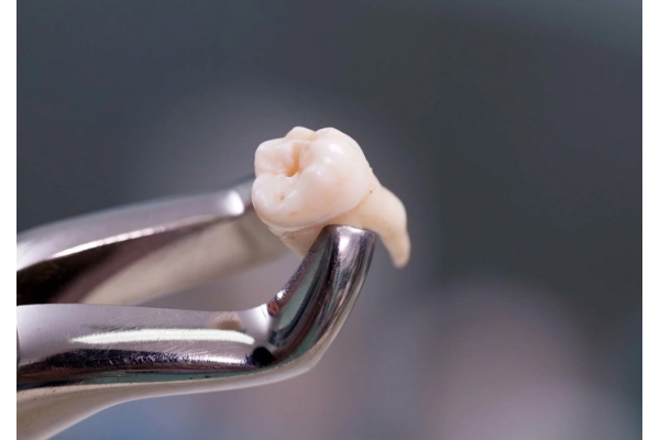 Удаление ретинированного и дистопированного зуба