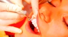 Снятие зубных отложений (1 зуб)