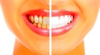 Удаление зубных отложений ультразвуком (обе челюсти)