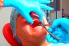 Удаление многокоренного зуба (простое)