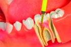 Лечение пульпита и подготовка 1-канального зуба к протезированию