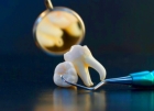 Удаление ретенированного, дистопированного зуба