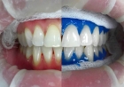 Нанесение на зуб отбеливающего препарата