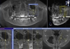Анализ и расшифровка КТ снимков стоматологом имплантологом