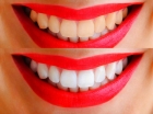 Внутрикоронковое отбеливание девитальных зубов