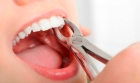 Удаление зуба (однокорневого)