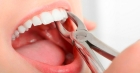 Удаление подвижной стенки зуба