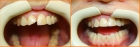 Реставрация зуба