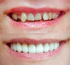 Художественная реставрация и эстетическая корректировка фронтальных зубов