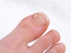 Коррекция вросшего ногтя Combiped (Комбипед)