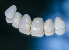 Коронка металлокерамическая на зуб 