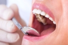 Восстановление зуба реставрационным материалом (II, IV, класс)
