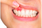 Покрытие зубов фторсодержащими лаками
