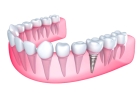 Протезирование зубов на импланте