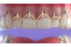 Операция удлинения коронковой части зуба