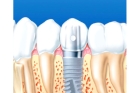 Импланты зубов недорого