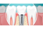 Импланты зубов дешево