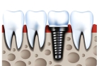 Импланты зубов по акции
