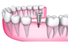 Имплант 1 зуба