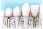 Имплант на передний зуб