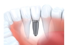 Импланты зубов при отсутствии