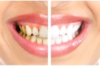 Протезирование  зубов на имплантах в стоматологии