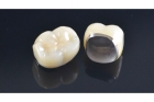 Коронки металлокерамика на задние зубы
