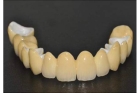 Циркониевая коронка в стоматологии