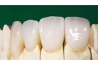 Восстановление зуба коронкой пластмассовой