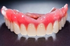 Рассрочка на протезирование зубов