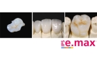 Восстановление зуба вкладками Е-мах