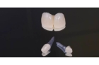 Восстановление зуба с использованием цельнолитой разборной культевой вкладки