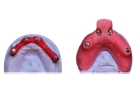 Снятие оттиска с одной челюсти индивидуальной ложкой при протезировании на имплантатах