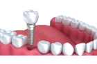 Протезирование зуба с использованием имплантата металлокерамической коронкой 