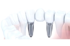 Протезирование зуба с использованием имплантата металлокерамической коронкой на титановом абатменте