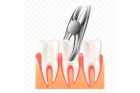Удаление подвижной части зуба